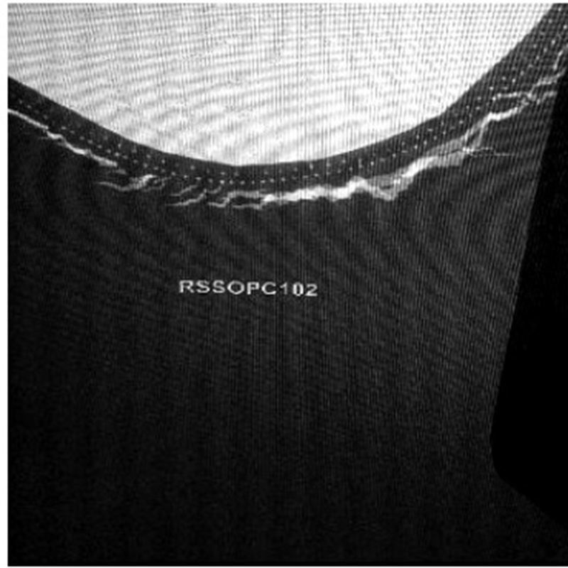 Durchleuchtungsaufnahme einer Röntgenschürze mit Knickschaden
